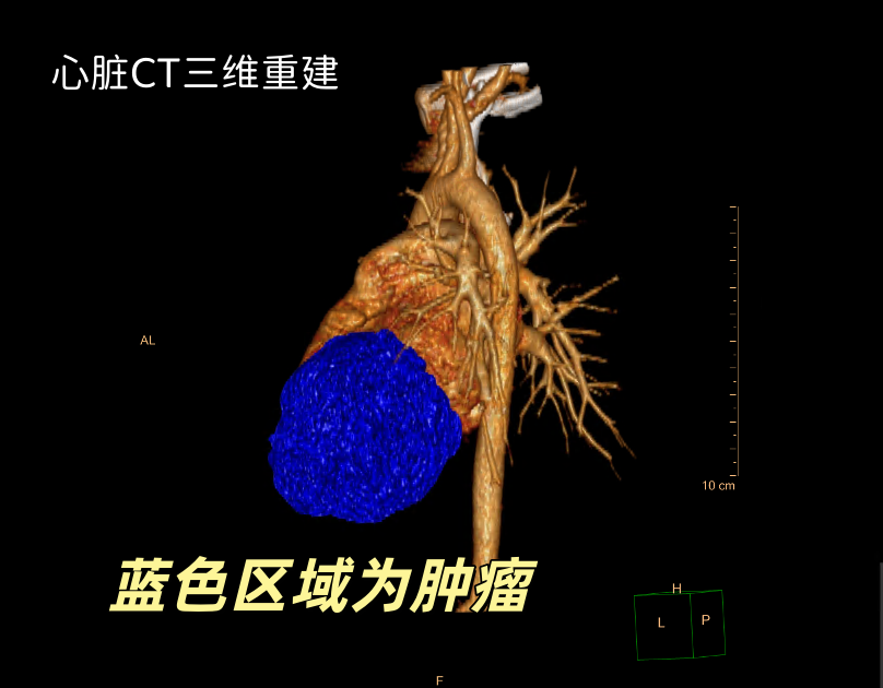 星星(化名)体内肿瘤示意图。 重医附属儿童医院供图